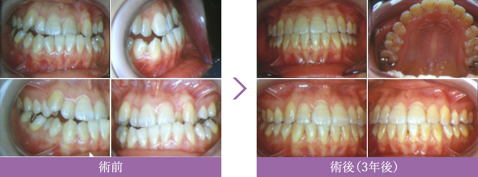 矯正歯科治療症例