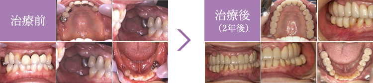 インプラント症例